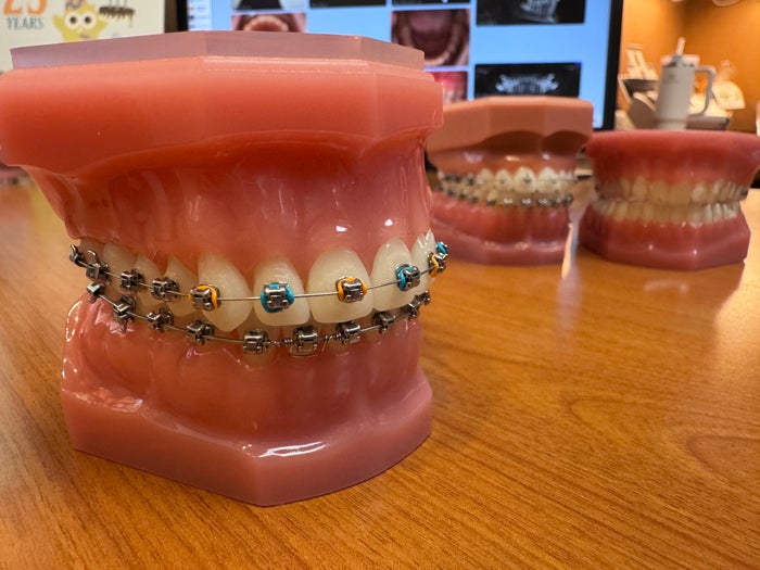 Orange and blue braces